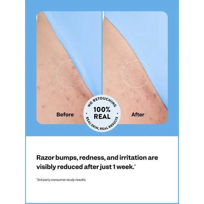 🔥Special Price Only Today!!!🍃 Smoothing Solution Ingrown Hair Treatment