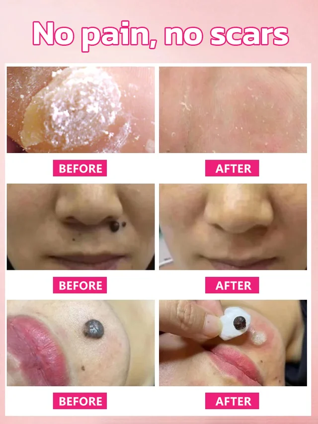 🔥Hot Sale 🔥 Herbal wart and corn removal cream