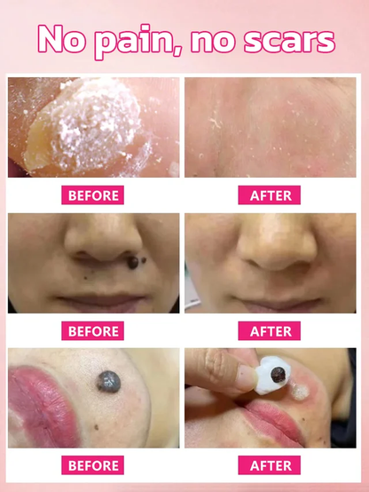 🔥Hot Sale 🔥 Herbal wart and corn removal cream