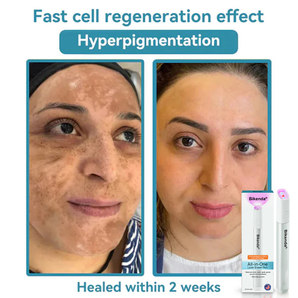 🔥Hot Sale🔥All-in-One CO₂ Laser Eraser Pen | Removes Moles, Warts, Skin Flaws & Pigmentation✨