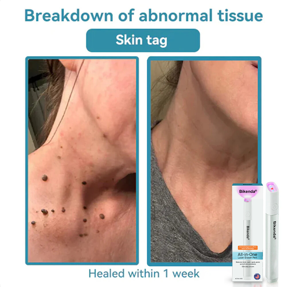 🔥Hot Sale🔥All-in-One CO₂ Laser Eraser Pen | Removes Moles, Warts, Skin Flaws & Pigmentation✨