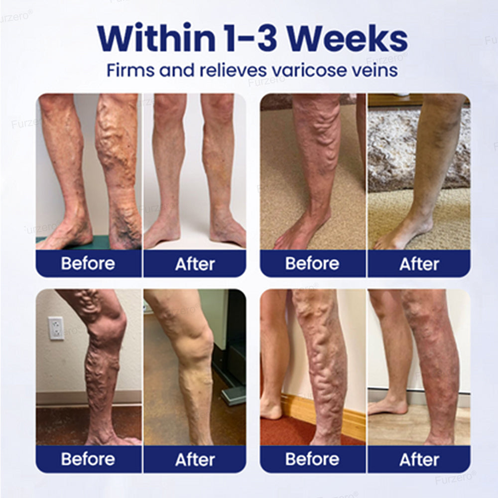 🔥Limited Time Discount 🔥Varicose Veins Herbal Spray - MicroMist Therapy