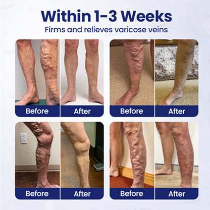 🔥Limited Time Discount 🔥Varicose Veins Herbal Spray - MicroMist Therapy