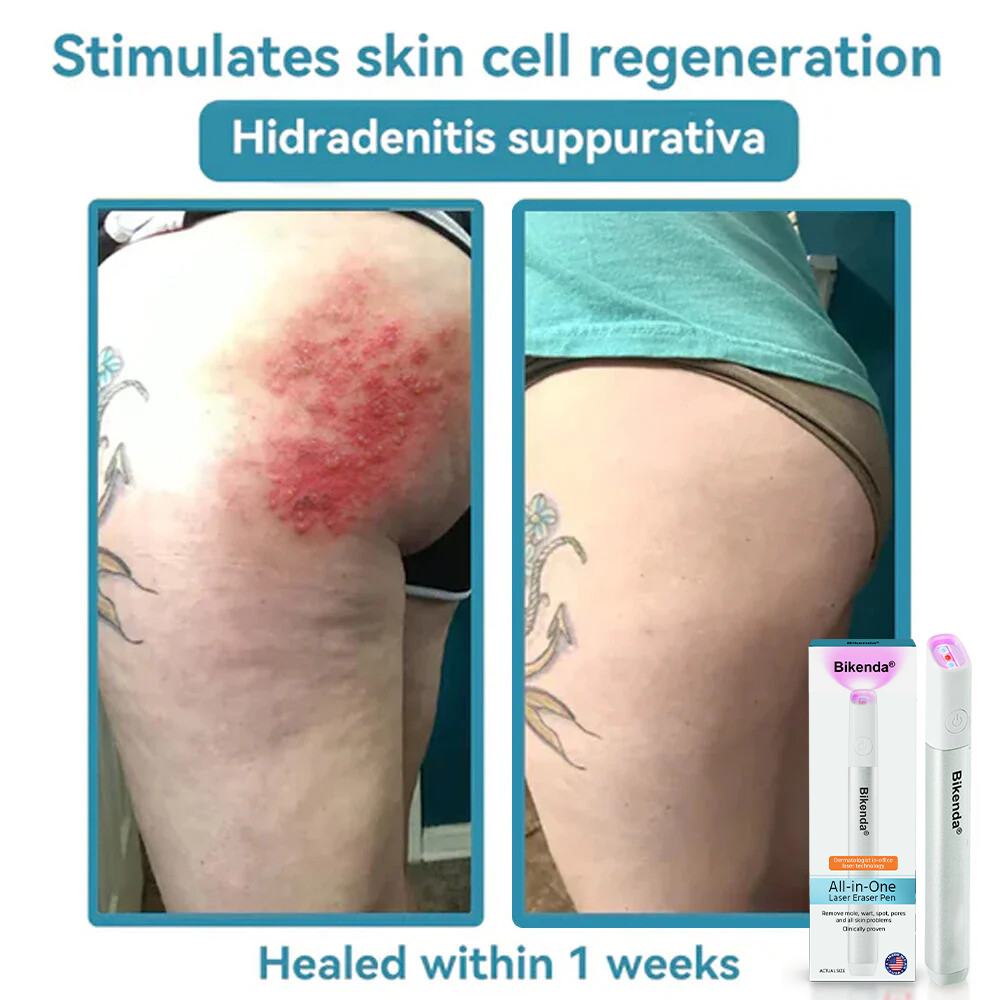 🔥Hot Sale🔥All-in-One CO₂ Laser Eraser Pen | Removes Moles, Warts, Skin Flaws & Pigmentation✨