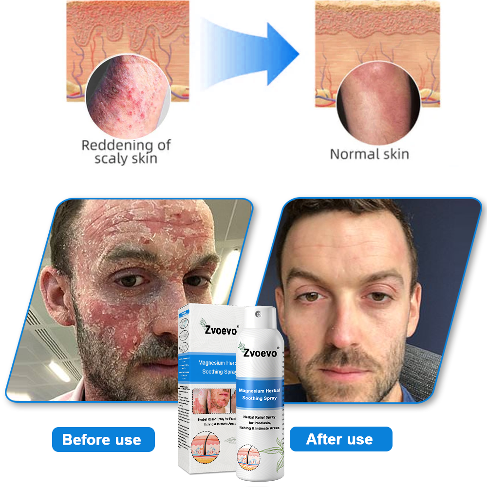 -50%OFF(🌲Early Christmas Sale🎁) Zvoevo® Magnesium Herbal Psoriasis Spray 👨‍⚕️ FDA Approved (Relieves psoriasis and eczema, improves bacterial infections in the genital area, hidradenitis suppurativa)