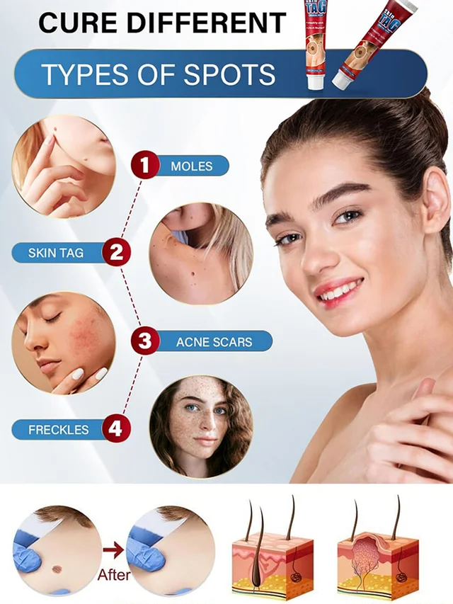 🔥Hot Sale 🔥 Herbal wart and corn removal cream