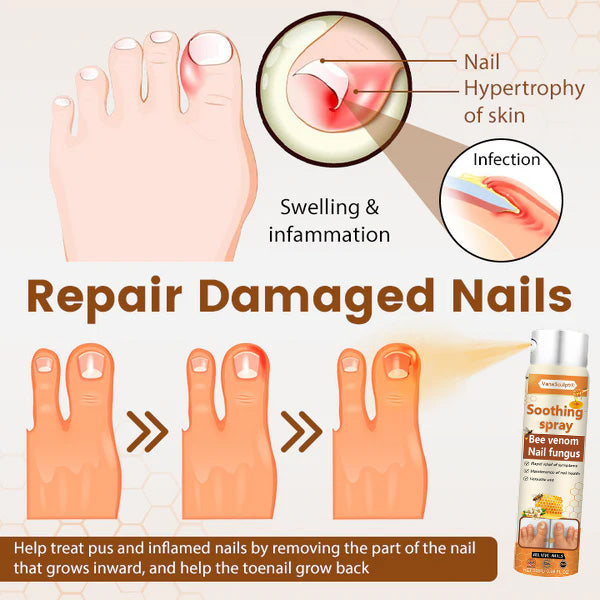 🔥Hot Sale🔥VanaSculpt® Bee Venom Nail Fungus Spray