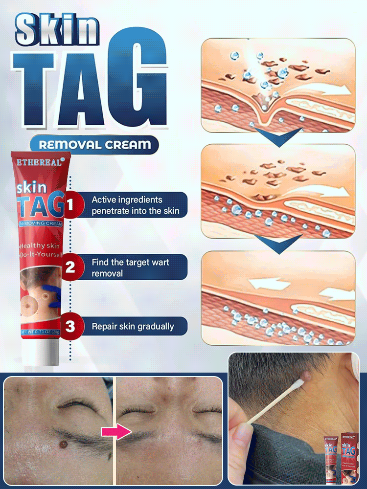 🔥Hot Sale 🔥 Herbal wart and corn removal cream