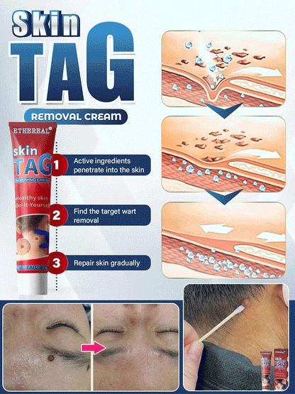 🔥Hot Sale 🔥 Herbal wart and corn removal cream