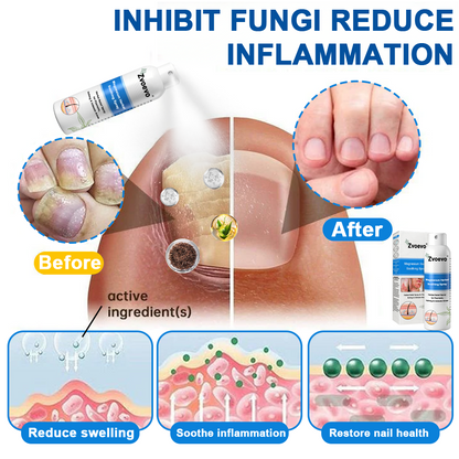 -50%OFF(🌲Early Christmas Sale🎁) Zvoevo® Magnesium Herbal Psoriasis Spray 👨‍⚕️ FDA Approved (Relieves psoriasis and eczema, improves bacterial infections in the genital area, hidradenitis suppurativa)