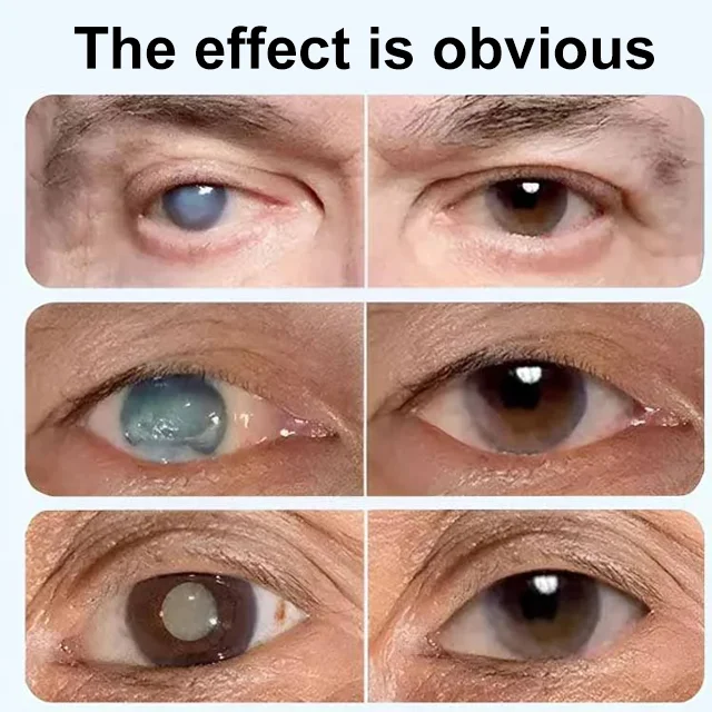 🔥Hot Sale🔥Blueberry Eye Dryness Treatment Liquid