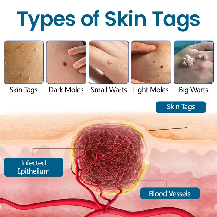 🔥Hot Sale🔥Timilk® DermaVenom RX+ Precision Removal Cream