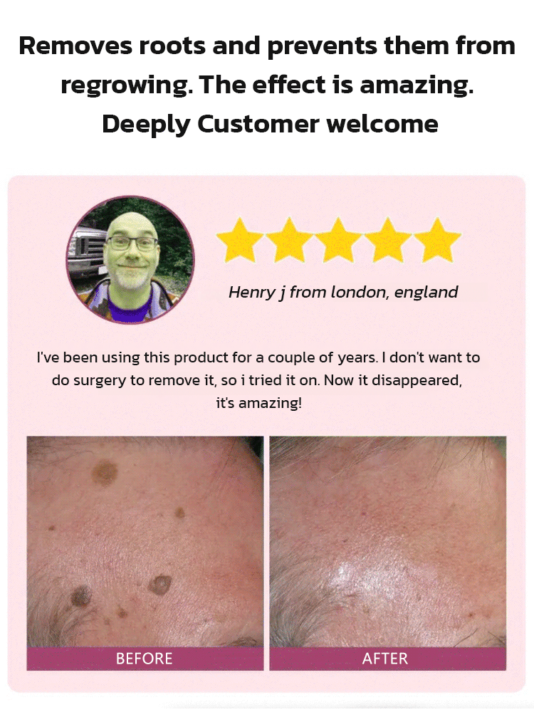 🔥Hot Sale 🔥 Herbal wart and corn removal cream