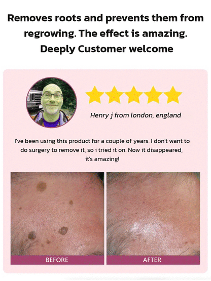 🔥Hot Sale 🔥 Herbal wart and corn removal cream