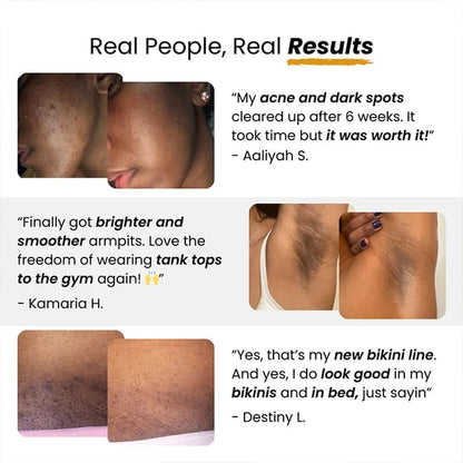 🔥Hot Sale 50% OFF🔥[Magic Spot Removal]Turmeric Kojic Acid De-darkening Handmade Soap