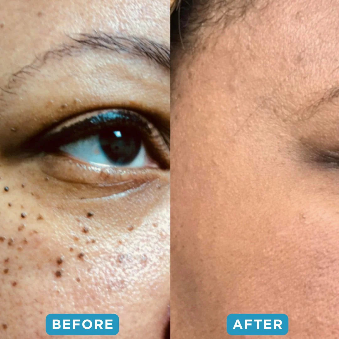 🔥Hot Sale 🔥 Natravor® Non-Invasive Mole and Wart Removal Laser Pen