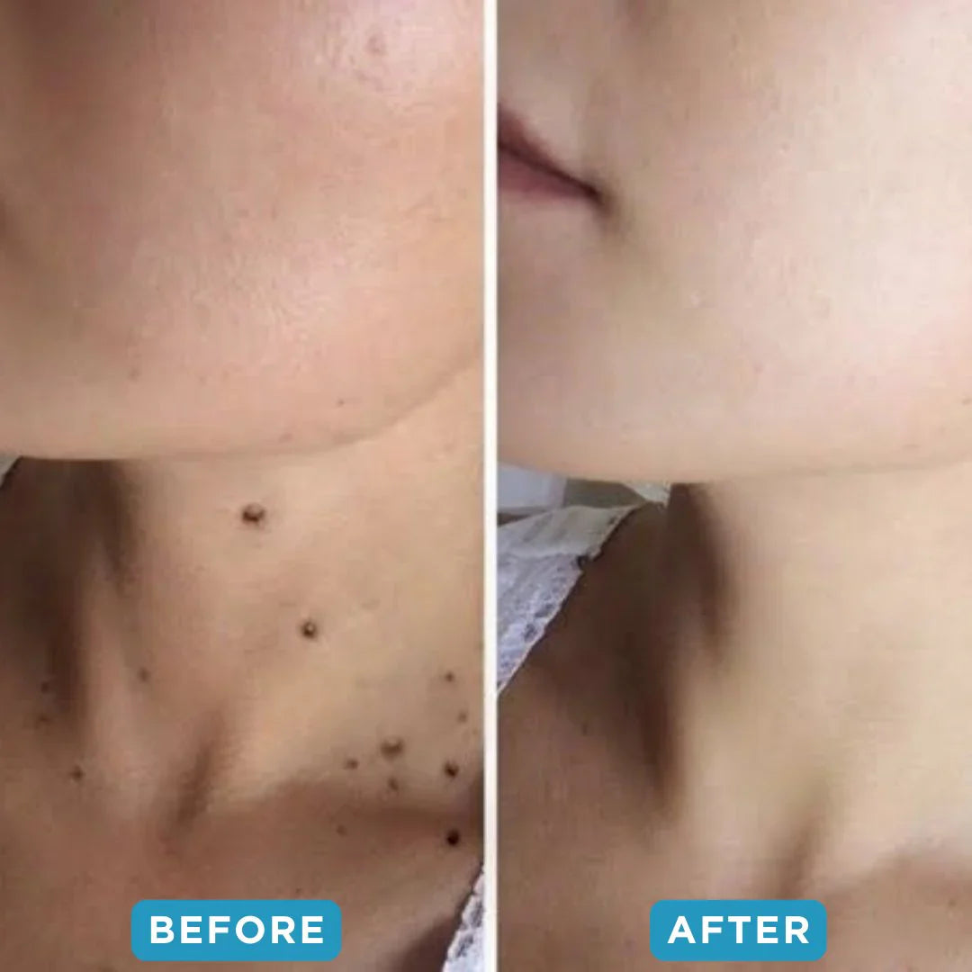 🔥Hot Sale 🔥 Natravor® Non-Invasive Mole and Wart Removal Laser Pen