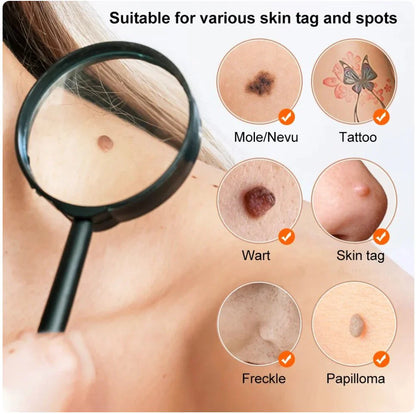 🔥Hot Sale 🔥 Natravor® Non-Invasive Mole and Wart Removal Laser Pen