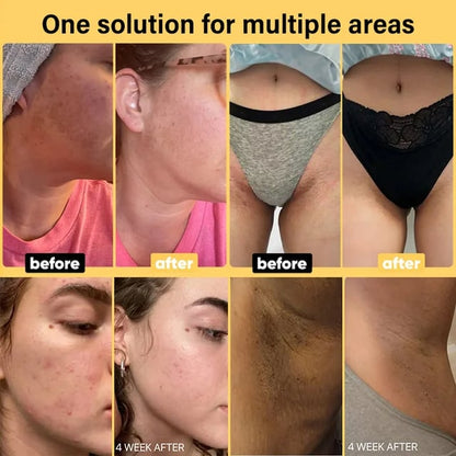 🔥Hot Sale 50% OFF🔥[Magic Spot Removal]Turmeric Kojic Acid De-darkening Handmade Soap